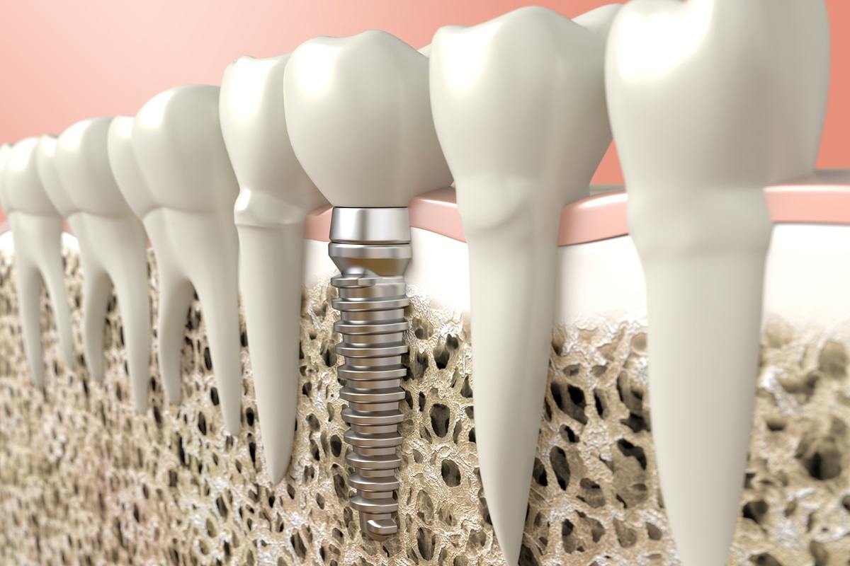 dental implants the complete guide to achieving a perfect smile