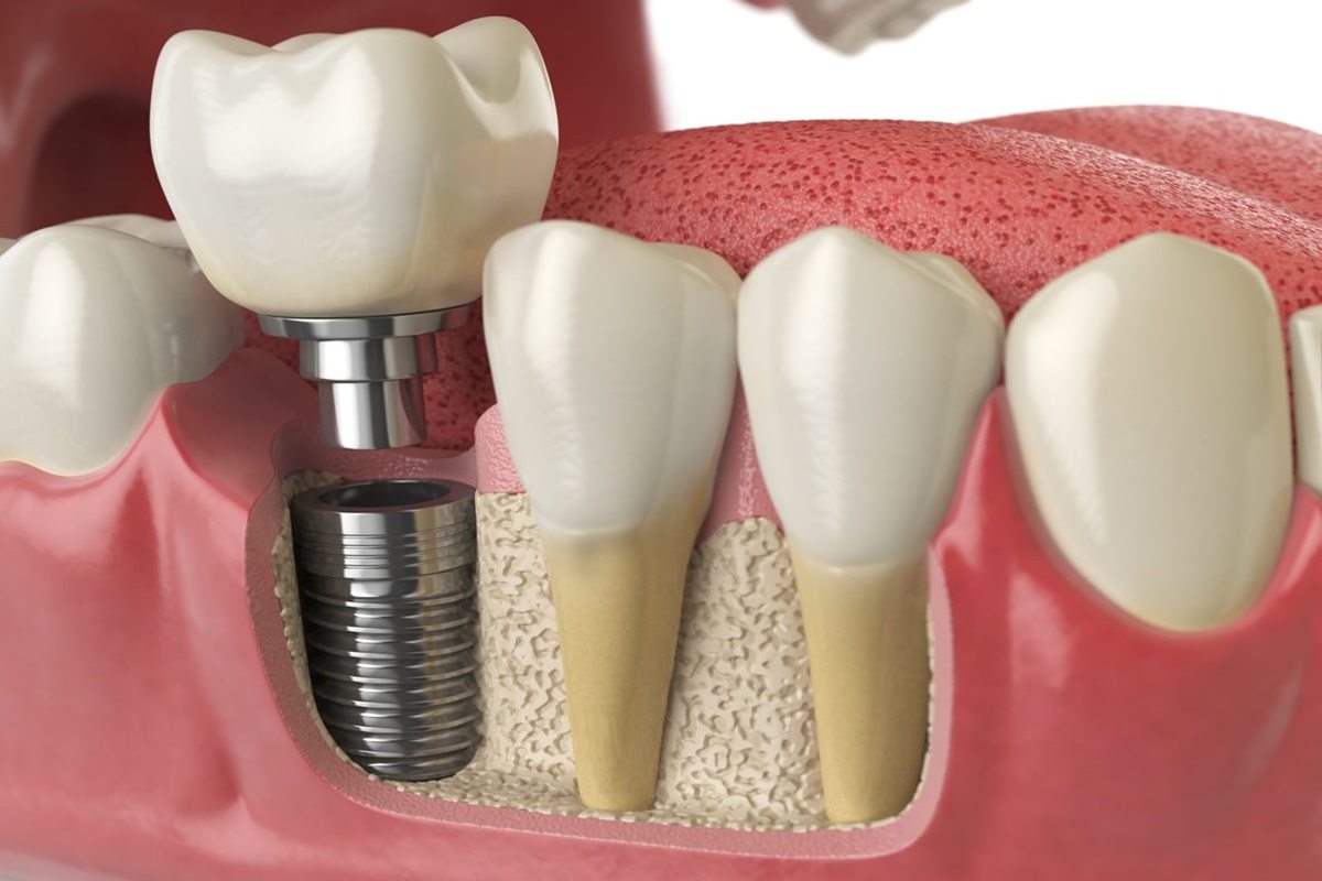 5 things to learn before your dental implants procedure