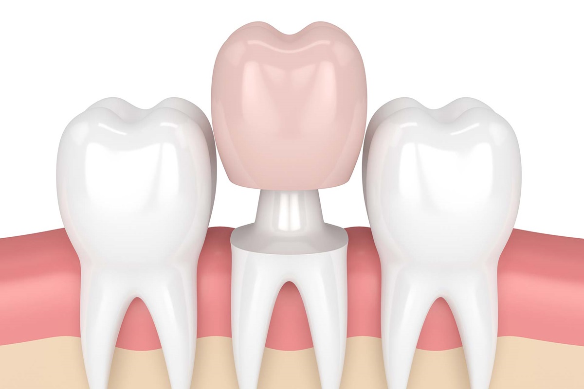 dental crowns what they are and when they needed